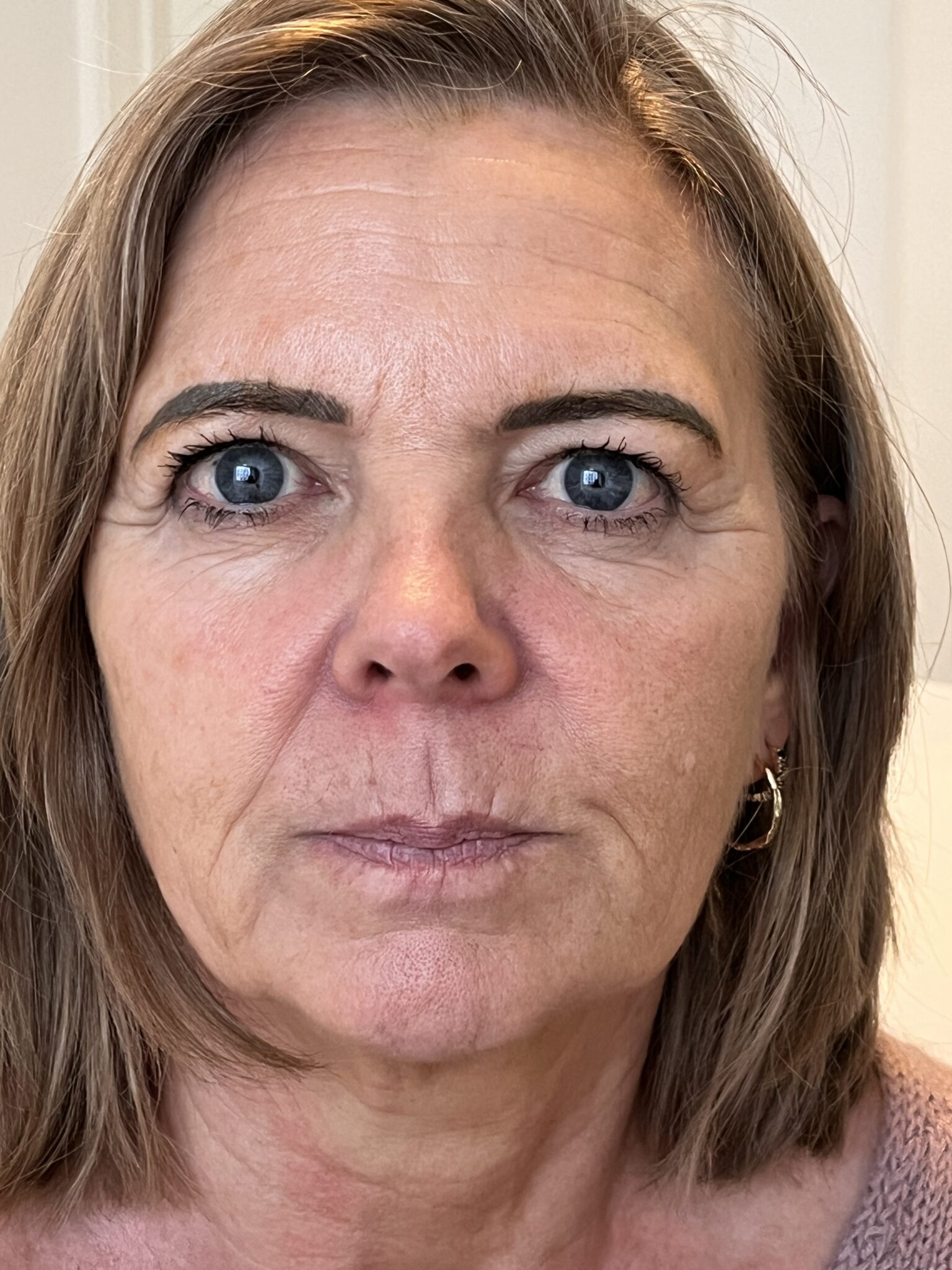 Fillerbehandling af midtkind og mundvige, efter